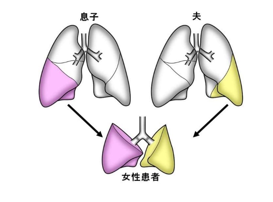 日本一名感染COVID-19女患者因嚴重後遺症造成肺部出問題,4月接受肺臟移植手術成全球首例。(圖取自京都大學網頁kyoto-u.ac.jp).jpg 日本一名感染COVID-19女患者因嚴重後遺症造成肺部出問題,4月接受肺臟移植手術成全球首例。(圖取自京都大學網頁kyoto-u.ac.jp).jpg